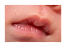 My baby has a lip tie. What now?