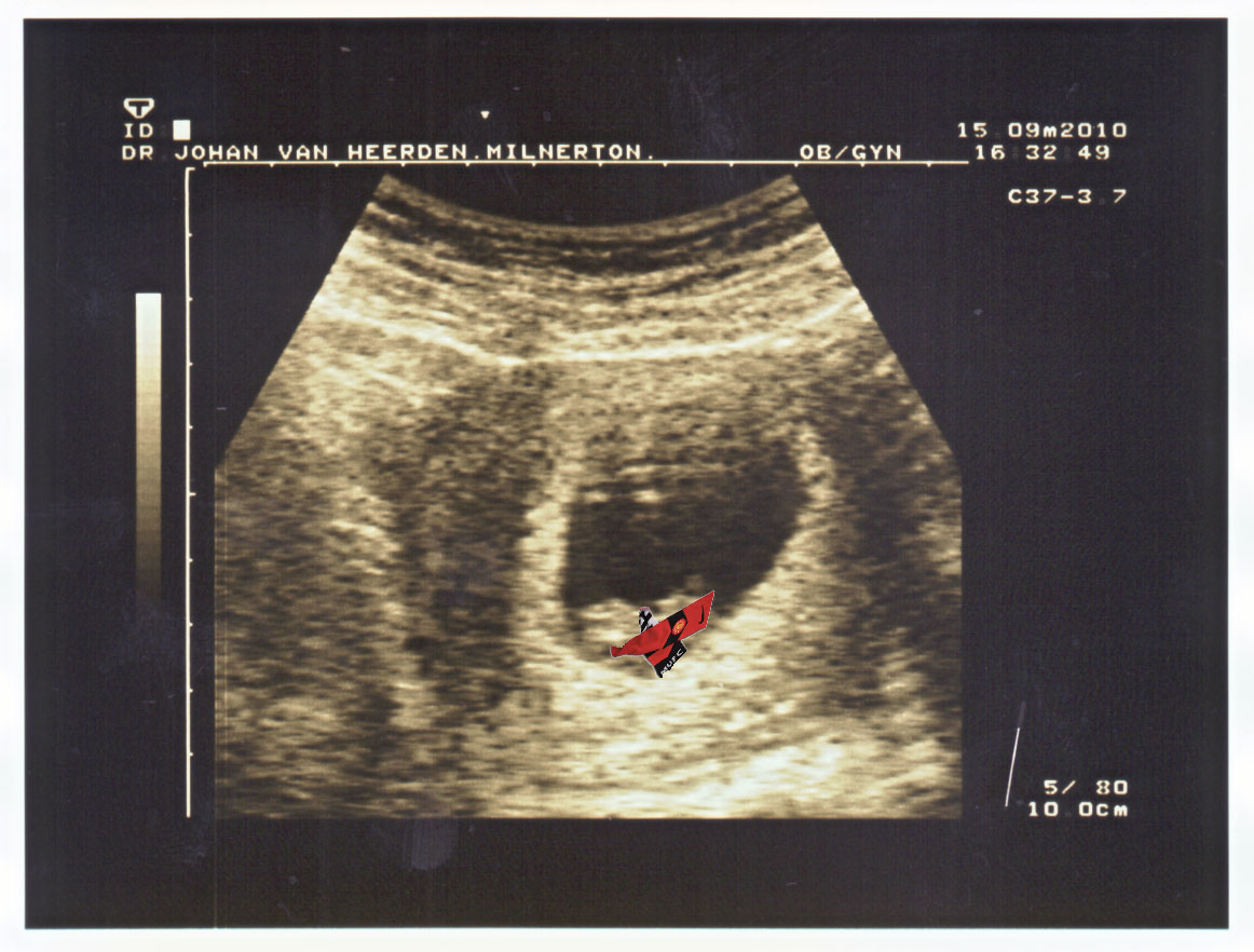 8_weeks_5_days_scan_of_the_chipolata_but_a_united_fan.jpg